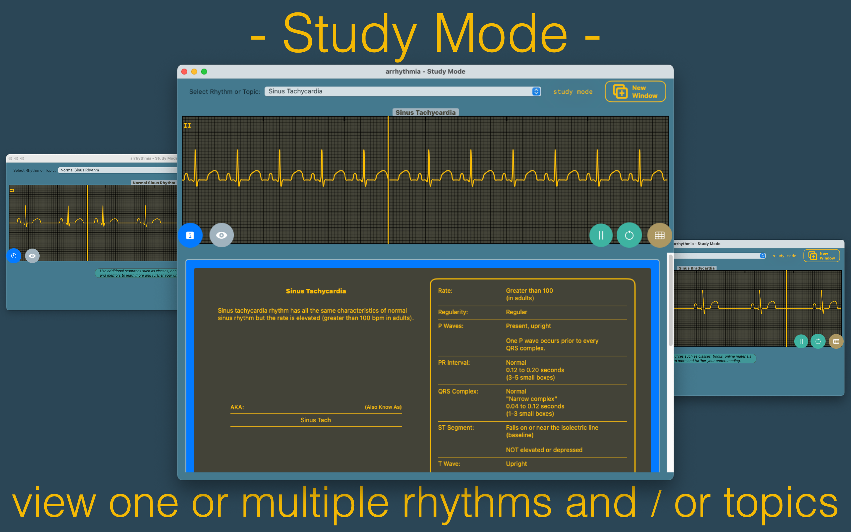 arrhythmia