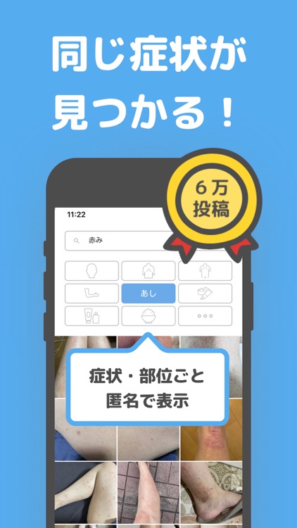 アトピー見える化アプリ-アトピヨ