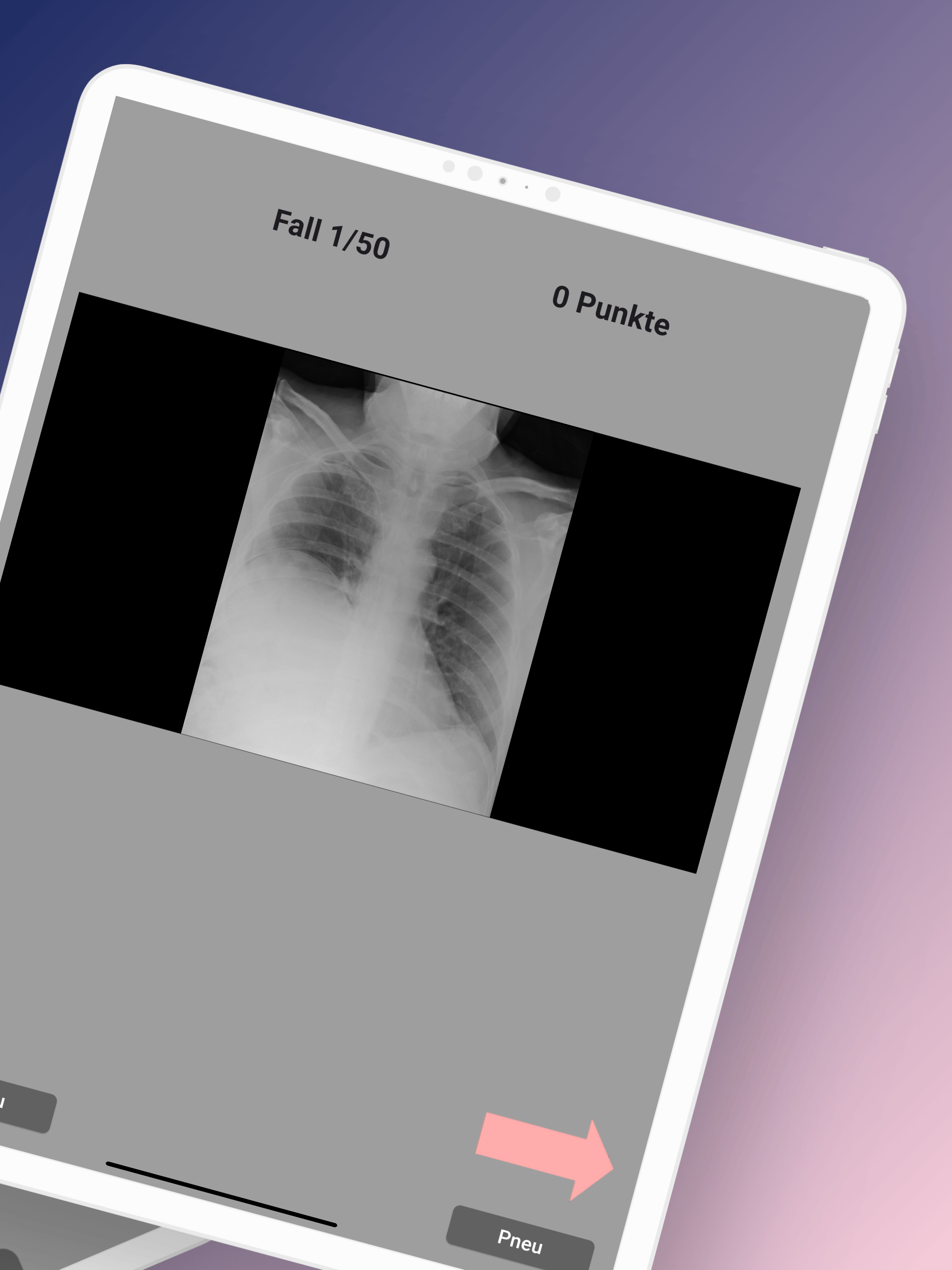 lulurad Pneumothorax screenshot 5