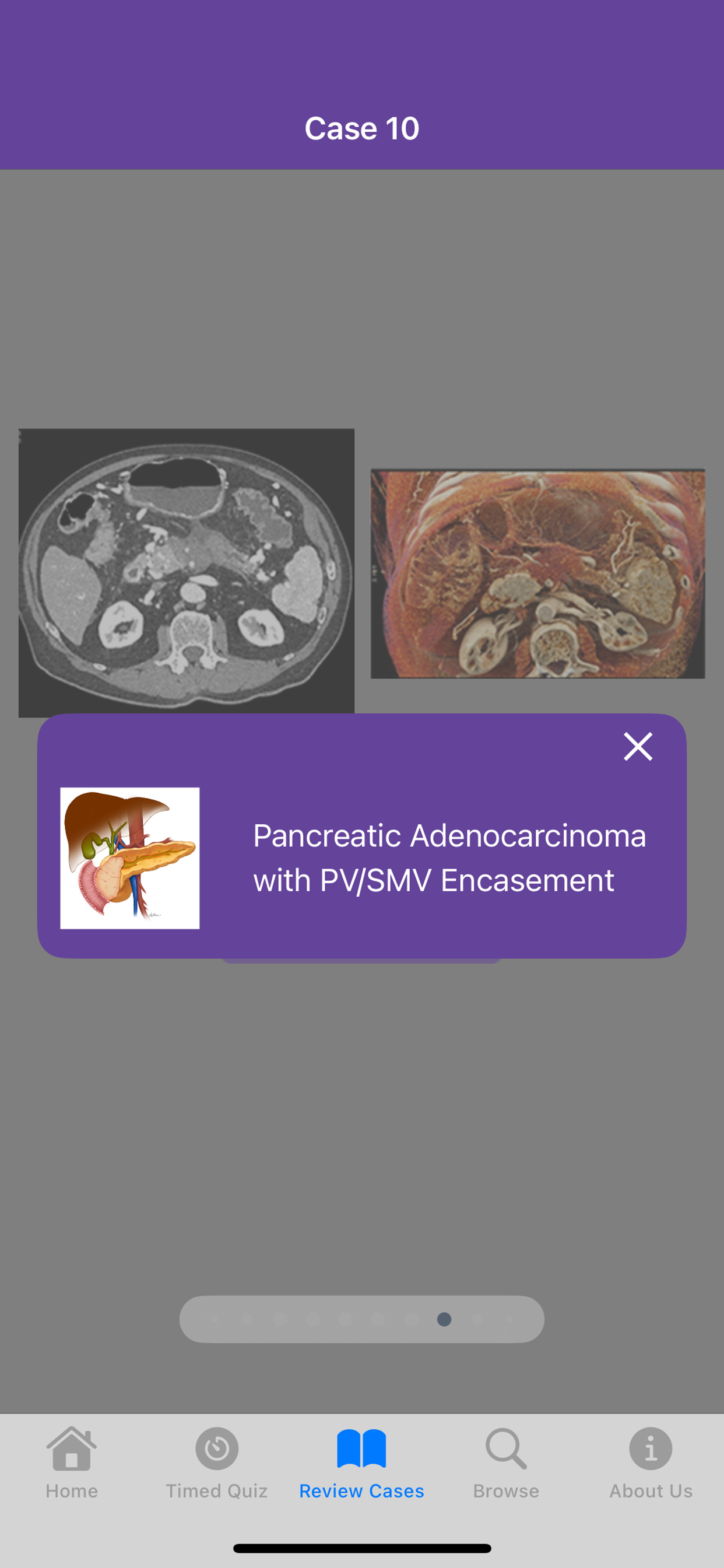 CTisus Pancreas Challenge