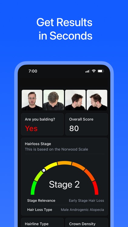 Hair Loss AI therapy & scanner