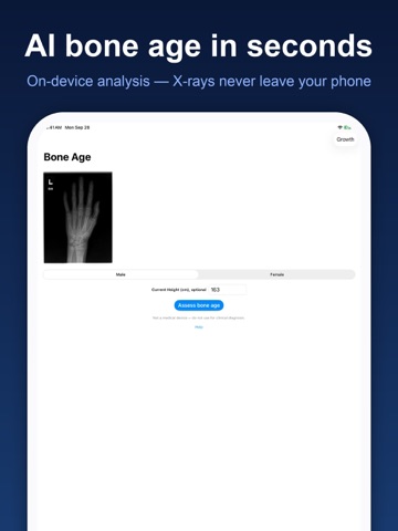 Bone Age : X-Ray Image Rater