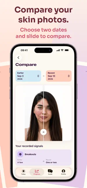 AcnePilot: Acne Tracker screenshot 3