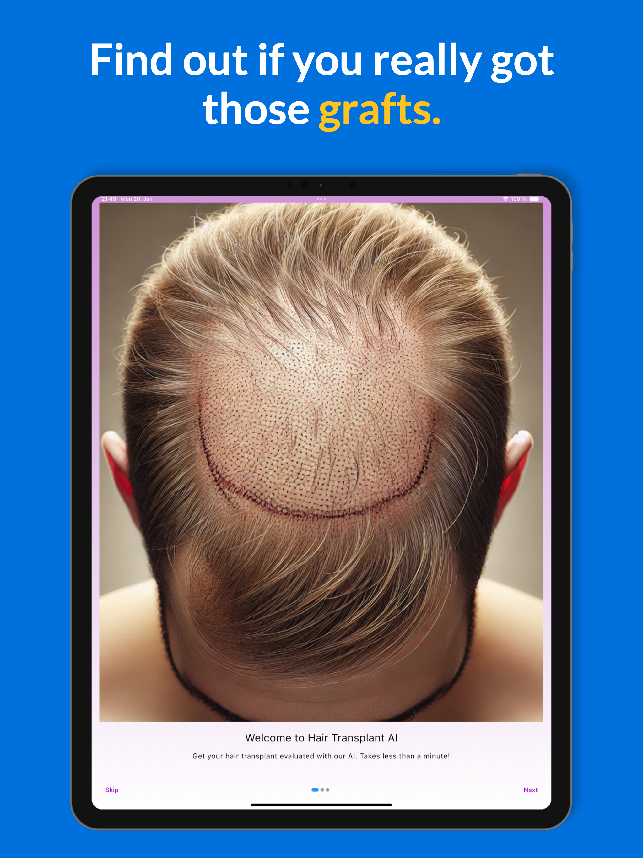Graft Count - Hair Transplant