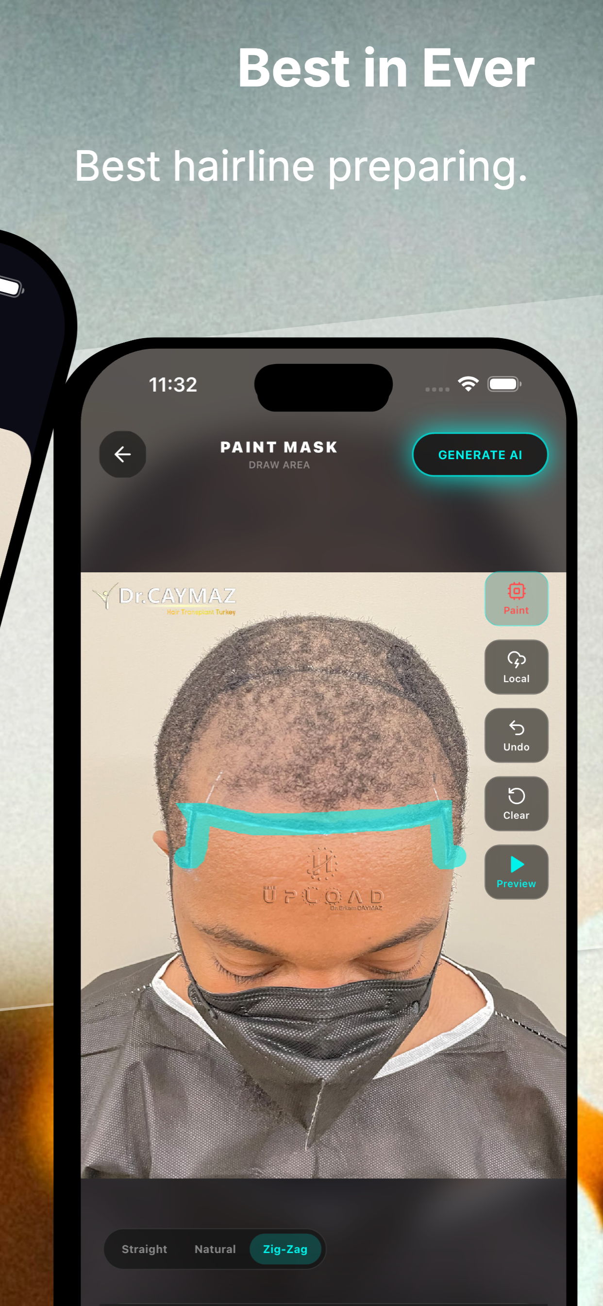 HairArchitect: AI Transplant