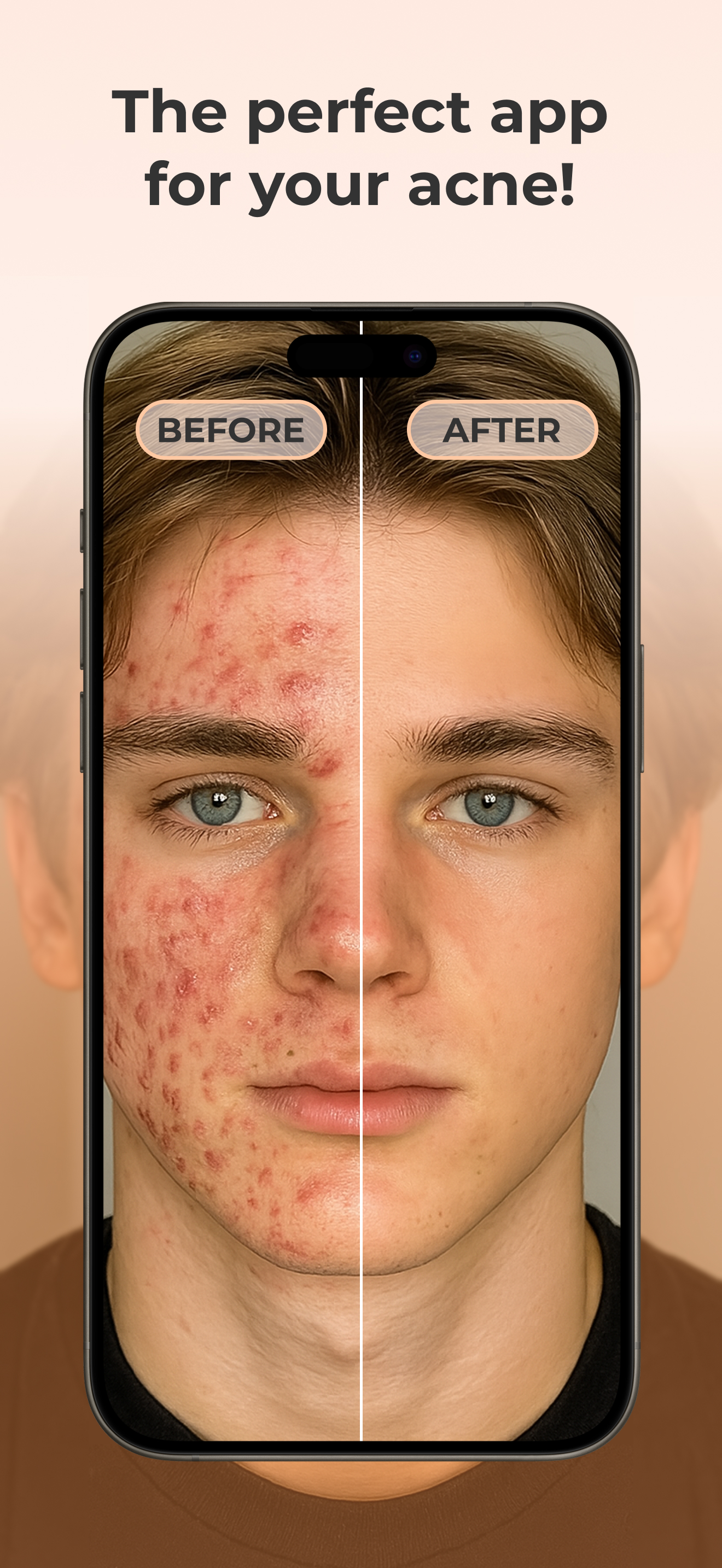 AcneTrack – Your Acne Journey