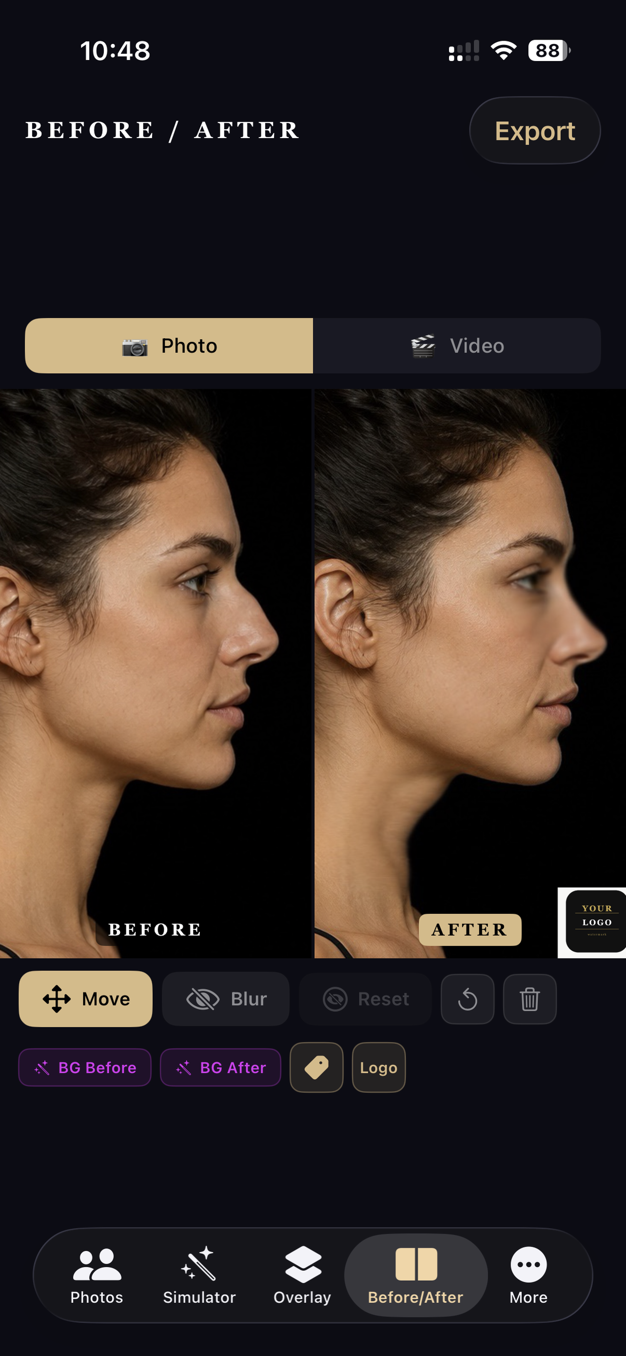 RhinoplastySimulator