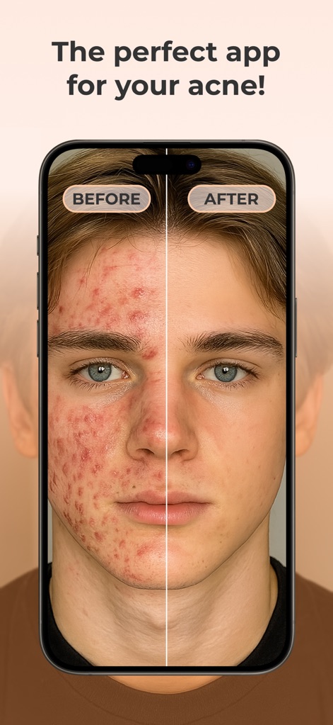 AcneTrack – Your Acne Journey - Users can immediately grasp the app's potential by seeing a compelling split-screen visual of skin's transformation and the prominent 'BEFORE' and 'AFTER' indicators.