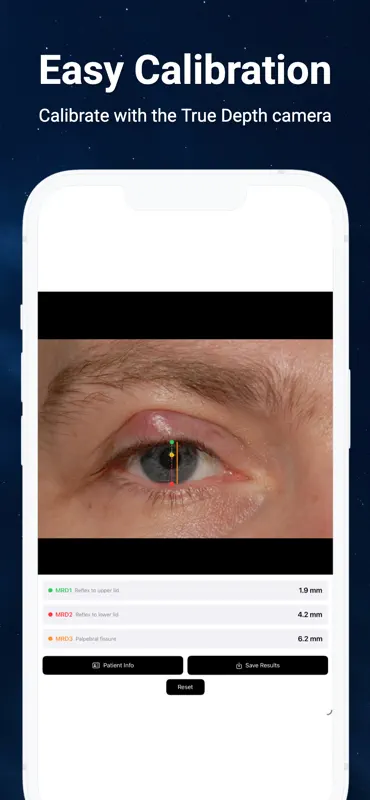 Eyelid, Ptosis, Blepharoplasty screenshot 1 of 3