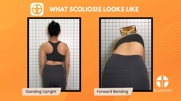 Scoliometer screenshot-1