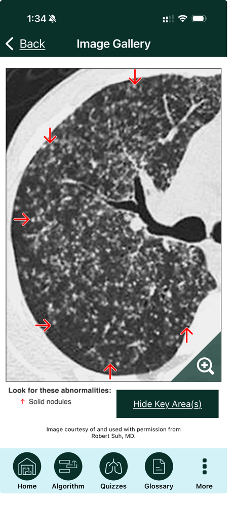 Rad Rounds UIP to IPF screenshot 5