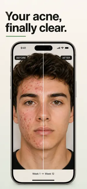 Scout - Acne Coach & Tracker screenshot 1