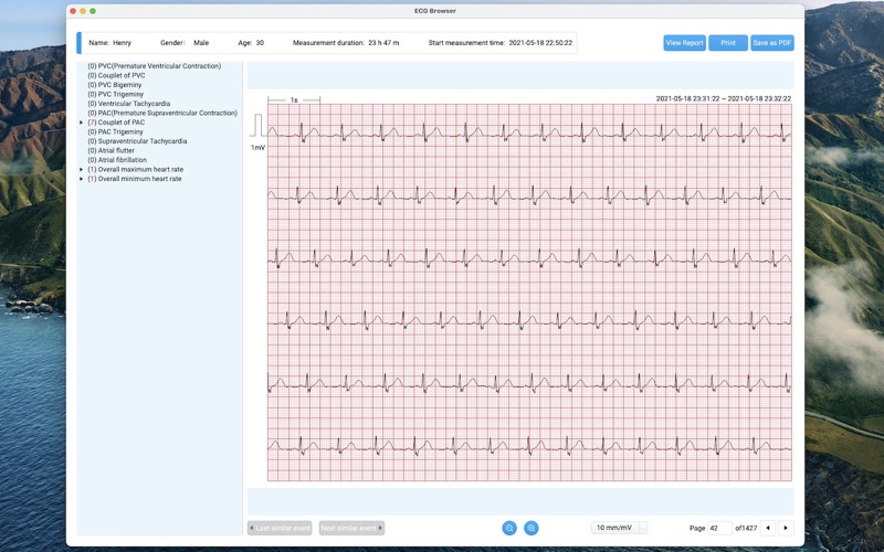 Screenshot #2 pour AI-ECG Analysis System