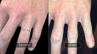 Removery Tattoo Removal & Fading photo 6